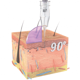 90 graus - fixação 90 graus - fixação
