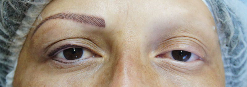 Alopécia Areata, mais uma vitória