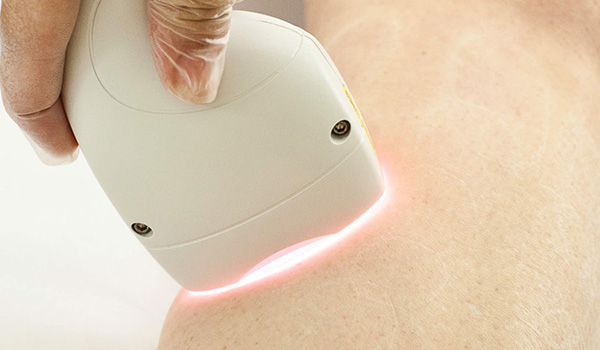 depilacao_laser_definitivo depilacao_laser_definitivo
