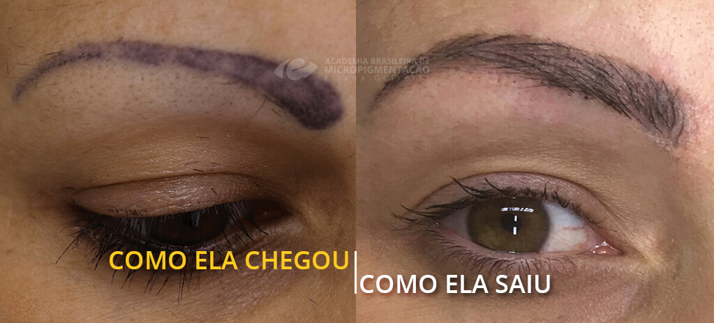 Despigmentação de Sobrancelha antes e depois
